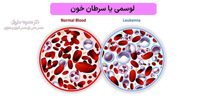 انواع لوسمی یا سرطان خون