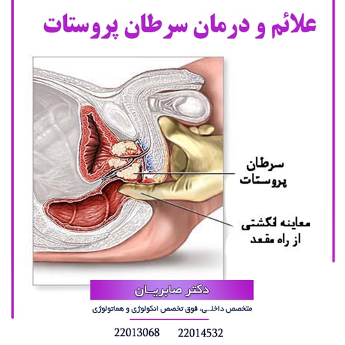 علائم و درمان سرطان پروستات