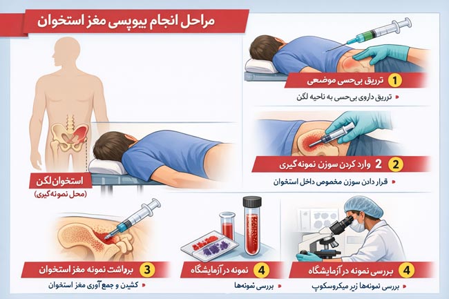 مراحل بیوپسی مغز استخوان
